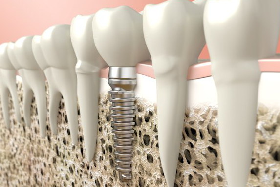 Implantes dentales